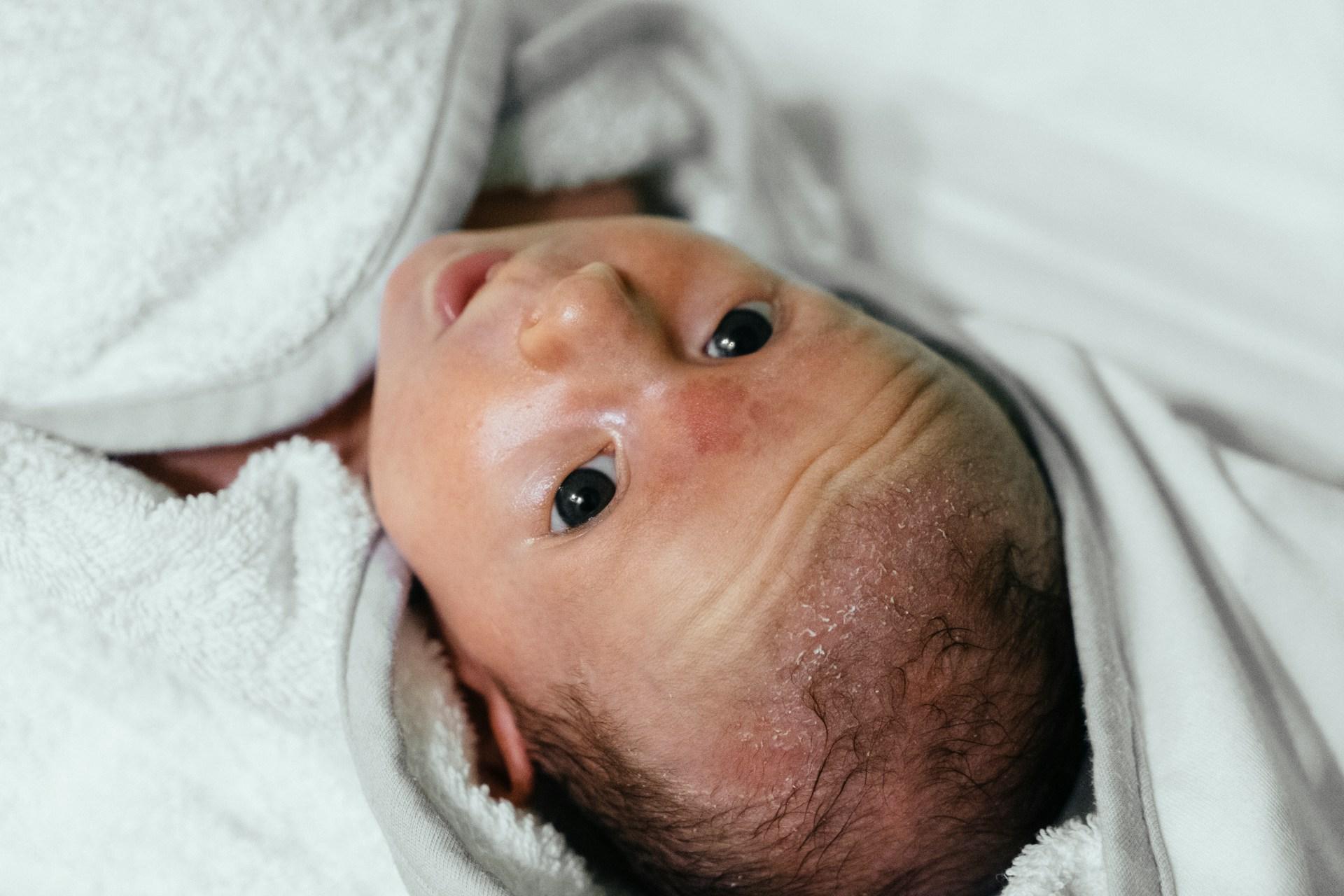 Newborn Acne: Causes, Care, and When to See a Doctor
